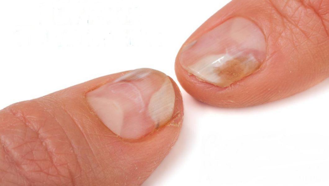 iodul poate vindeca ciuperca unghiilor de la picioare)
