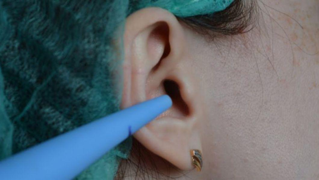 femeie ce urmeaza tratament pentru dopuri de ceara din urech