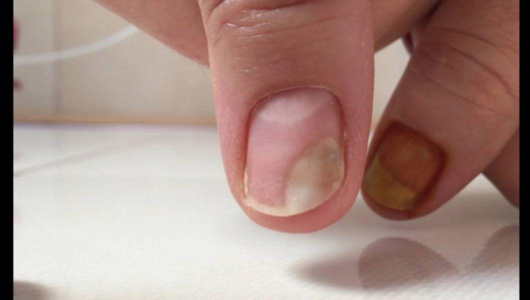 De ce este ciuperca unghiilor doar pe un deget?)