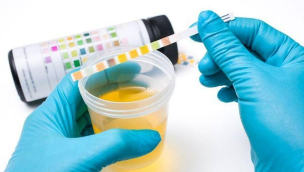 examinare probă de urină