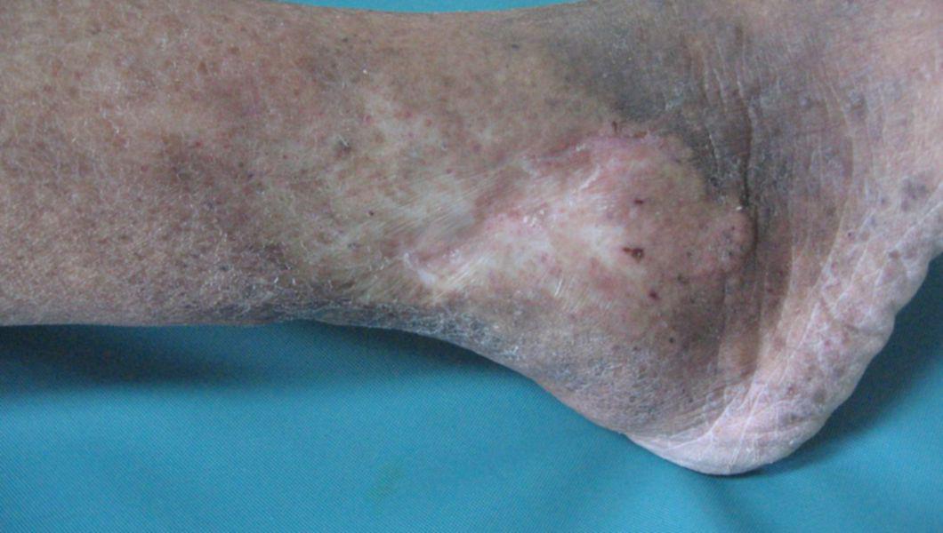 tratamentul intern de picior varicos