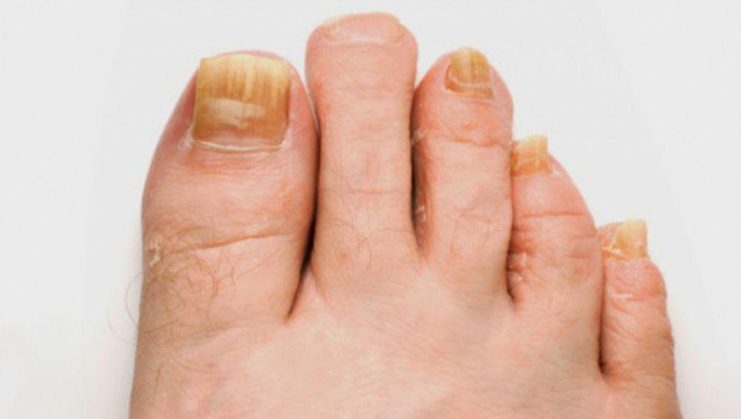 ciuperca degetelor de la picioare problema unghiilor
