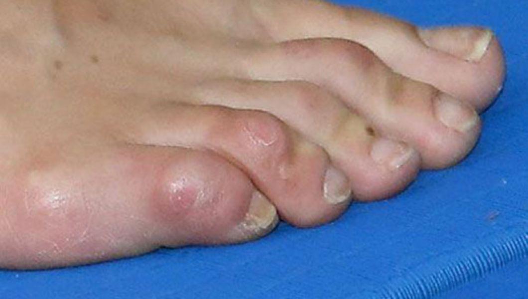 bataturi la degetul mic al piciorului unei persoane