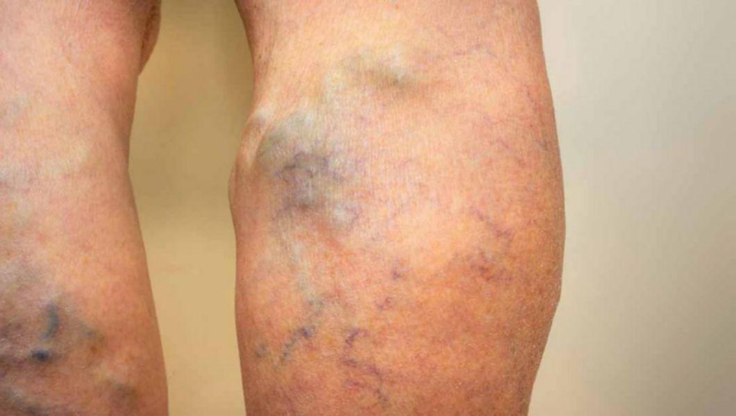 vase de sange infundate pe piciorul unei persoane