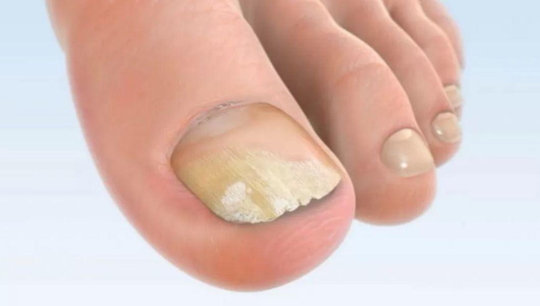 cum să vindeci 100% ciuperca unghiilor de la picioare)