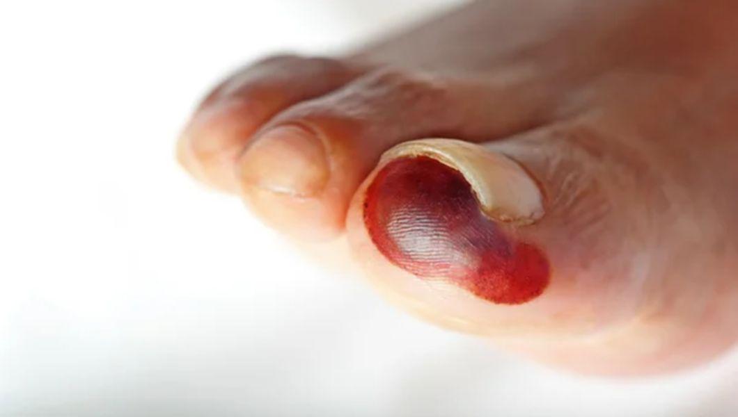 piciorul unei persoane afectat de cangrena
