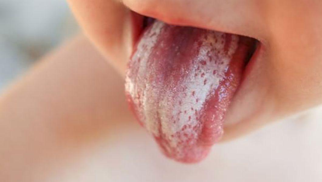 ciupercă în gât și pe limba unui copil