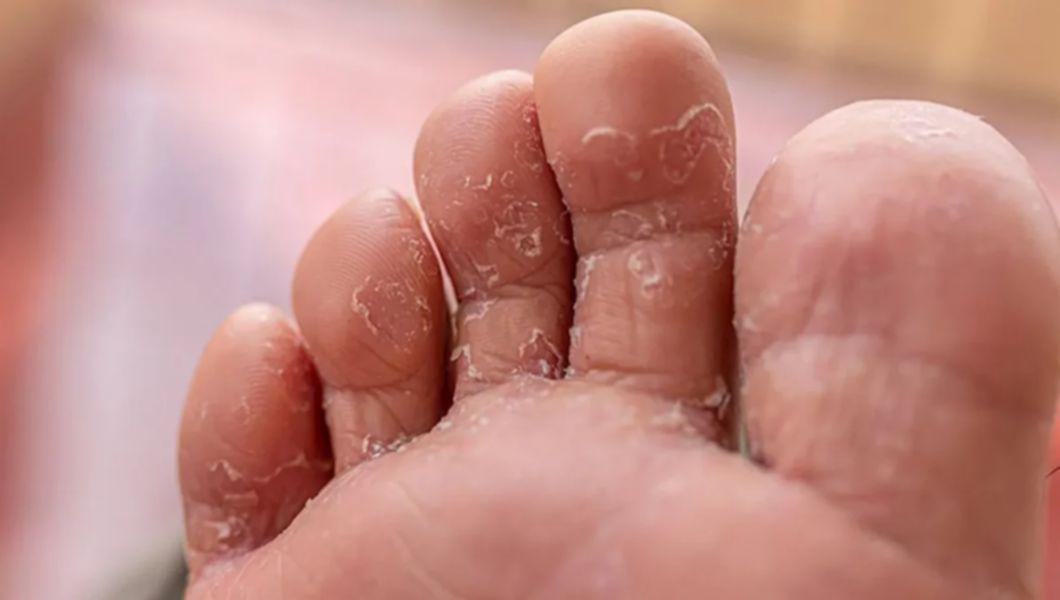 degetele de la picioare ale unei persoane afectate de ciuperca