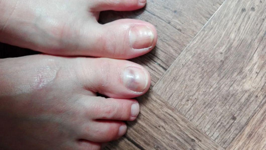unghiile de la picioare a unei persoane care sufera de melanom