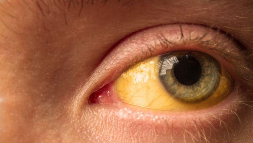 ochiul galben al unei persoane