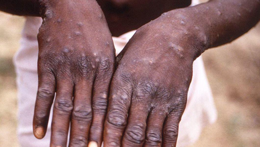 mainile unui pacient care are variola maimutelor