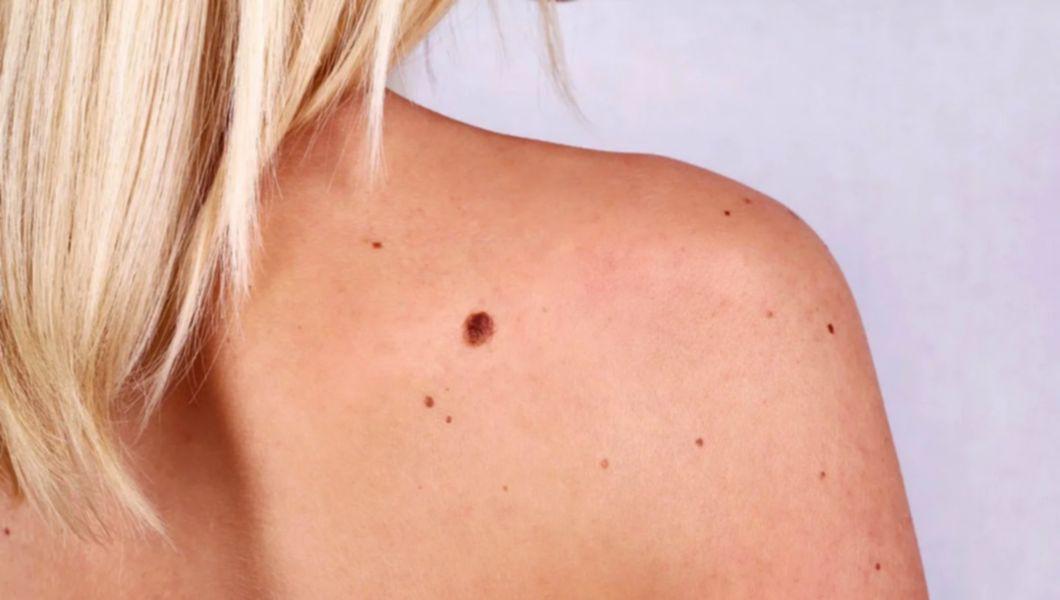 femeie care are un melanom pe spate