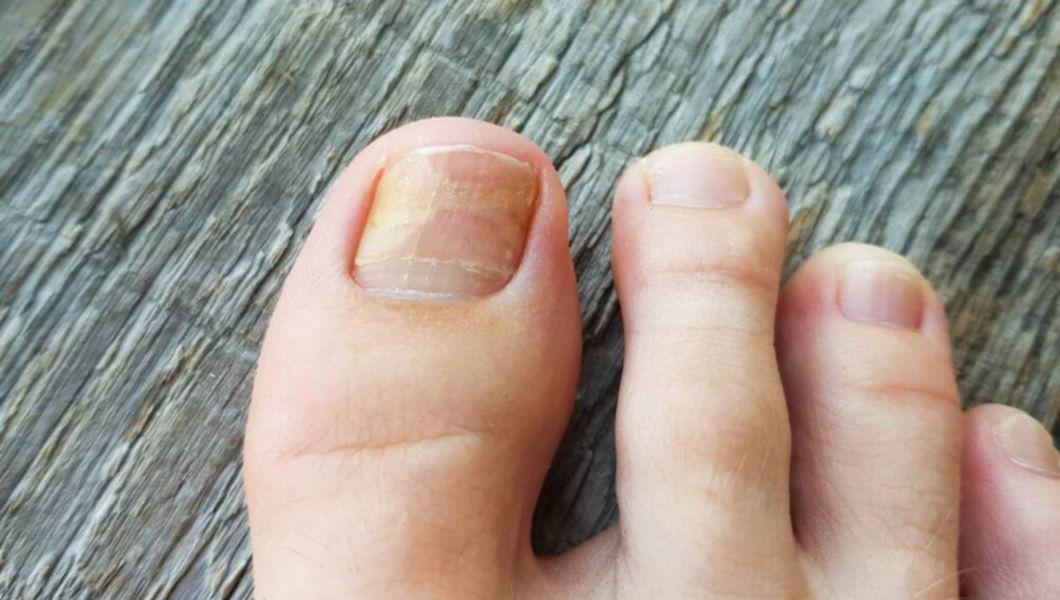 tratamentul ciupercii unghiilor de la picioare cu antibiotice