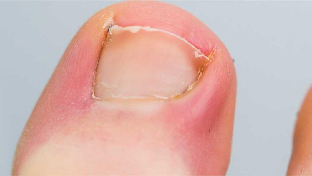 stadiu avansat al tratamentului ciupercii unghiilor de la picioare