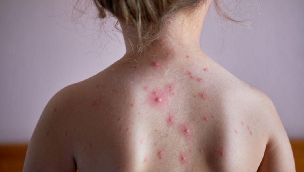 leziuni cutanate pe corpul unui copil provocate de varicela