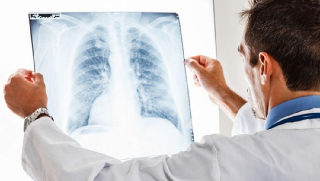 un medic care se uită la o radiografie pulmonară