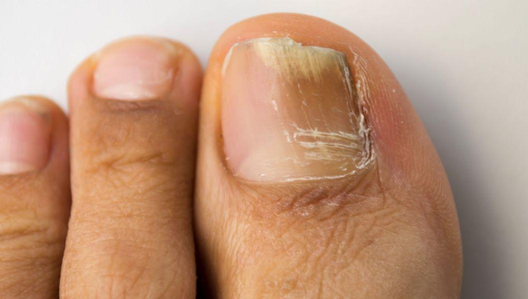 ciuperca neglijată pe unghia de la picior cum să trateze ce ucide rapid ciuperca unghiilor