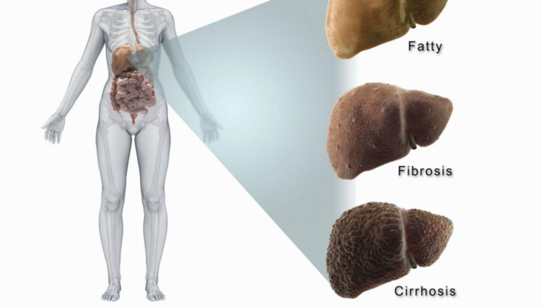 Cum Stii Ca Ai Fibroza Hepatica Simptome Si Stadii Buna Ziua Iasi Bzi Ro