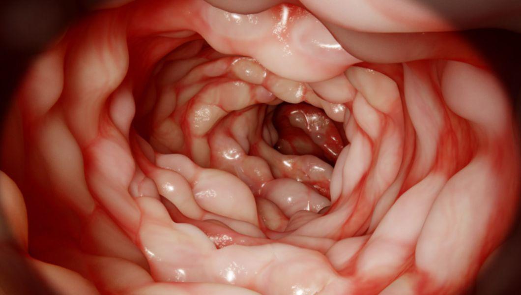 Recunoașterea și tratarea bolii Crohn
