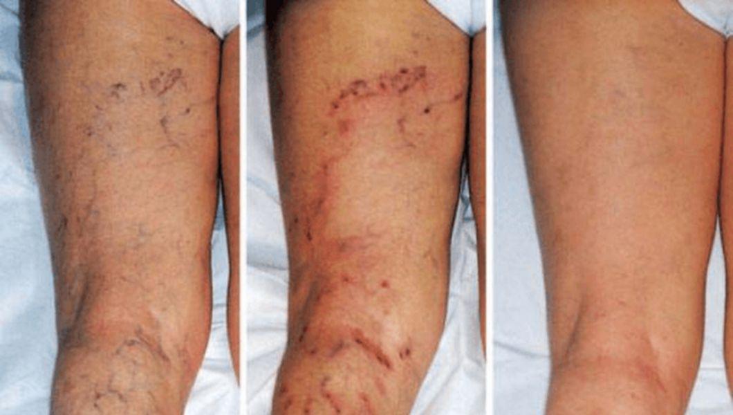 Varice în picioare, tratament home, Vindeca varicele cu medicina traditionala