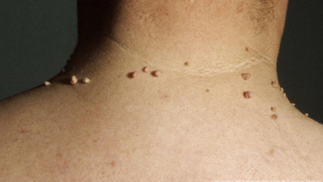 papiloamele de pe spate pot fi îndepărtate intraductal papilloma itchy