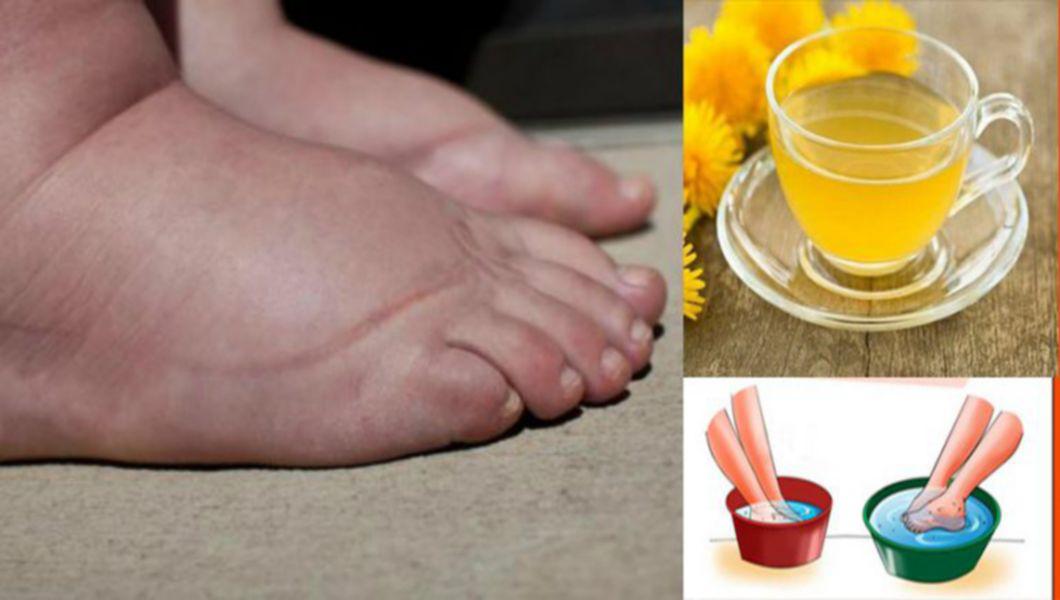remedii naturale pentru picioare umflate)