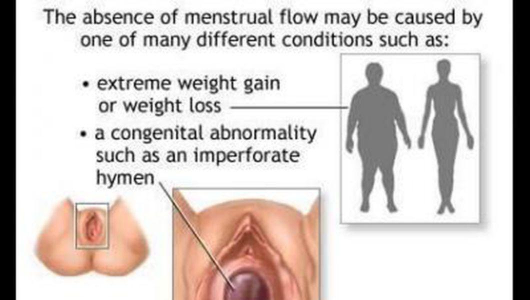 Amenoreea Sau Lipsa Menstruatiei Galerie Foto Bzi Ro