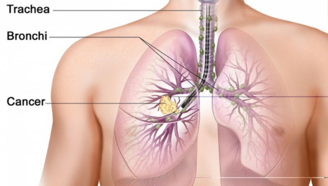 dureri articulare cancer pulmonar