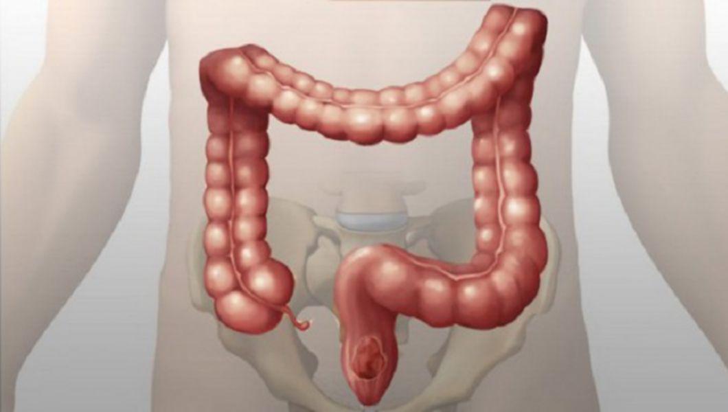 Apendicele Organul Inutil Ar Putea Avea O Functie Biologica Importanta Buna Ziua Iasi Bzi Ro