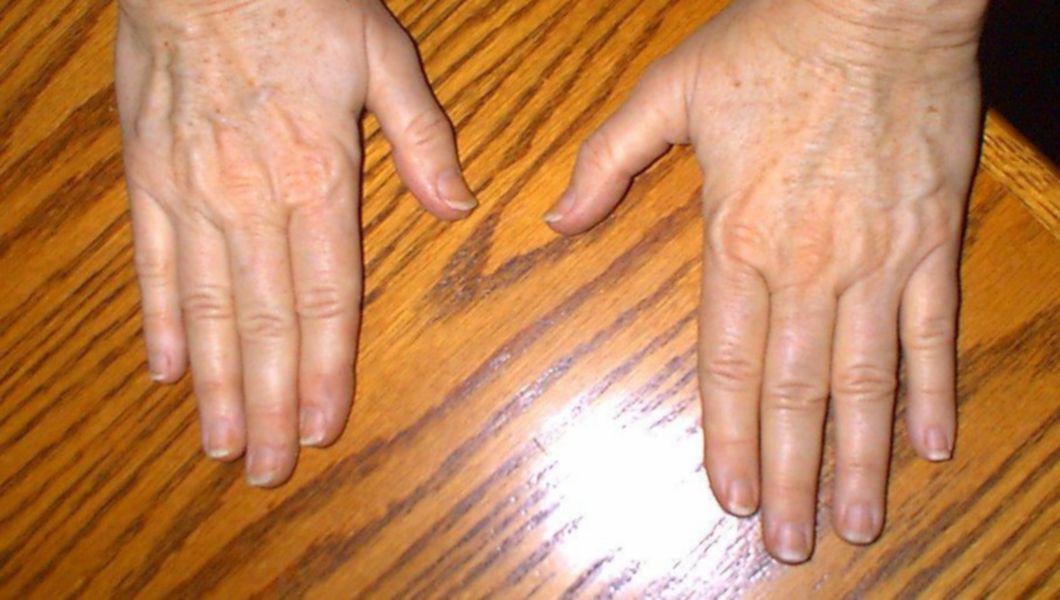 Tratamentul articulațiilor încheieturii mâinii și degetelor