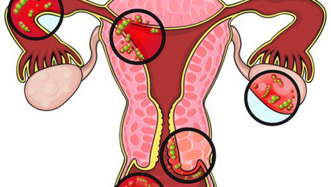 Ce trebuie sa stii despre endometrioza si cum se trateaza • Buna Ziua Iasi  • BZI.ro