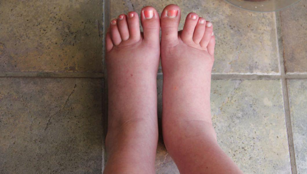 Sindromul picioarelor nelinistite