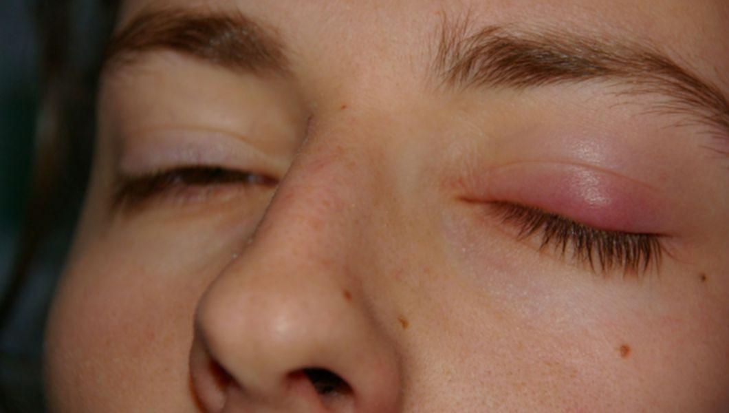 Ulcior la ochi – cauze, simptome și tratament - Clinica Ofta Total