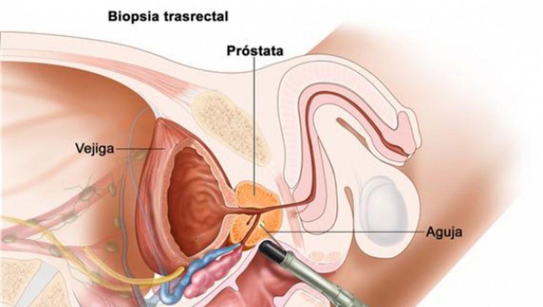 Remediu Eficient Pentru Cancerul La Prostata Buna Ziua Iasi Bzi Ro