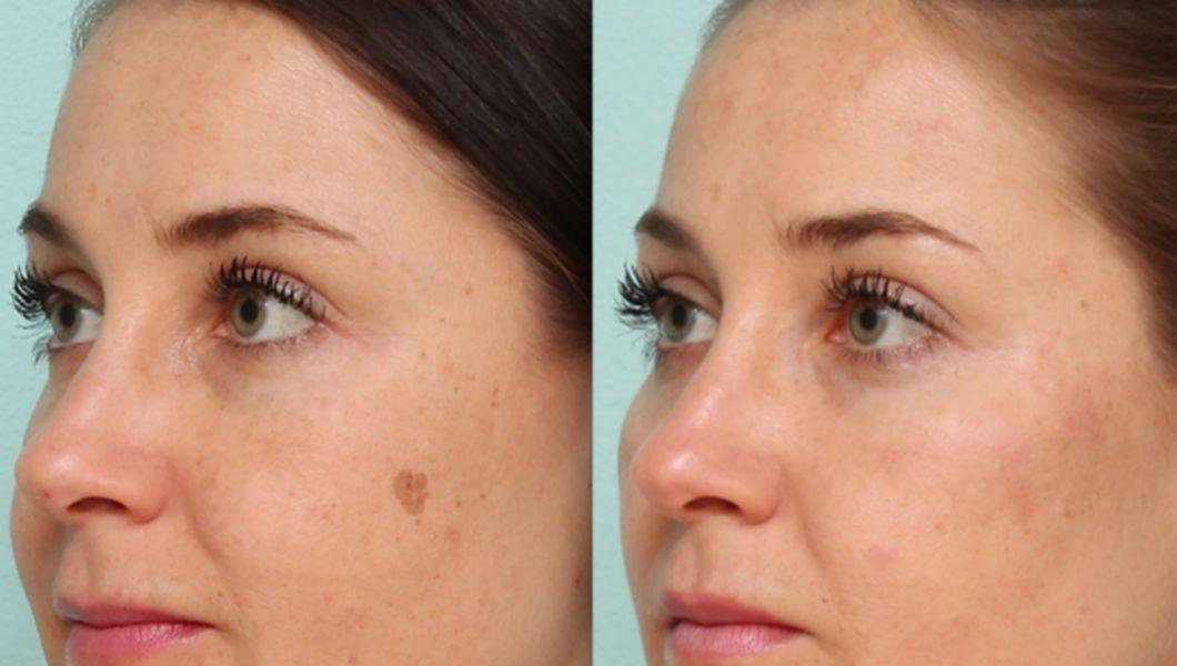 5 Remedii Naturale Pentru Petele Pigmentare Buna Ziua Iasi Bzi Ro