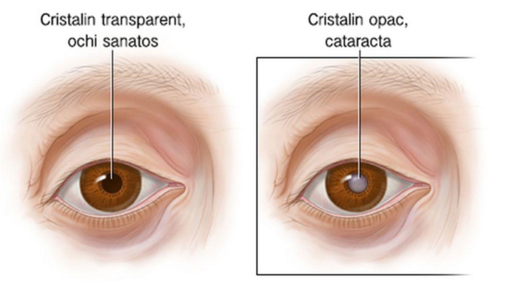 Trateaza Cataracta In Mod 100 Natural Iata Cum Buna Ziua Iasi Bzi Ro