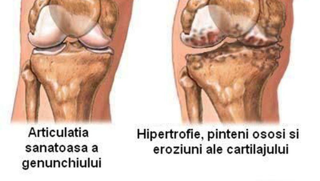 Artrită la genunchi