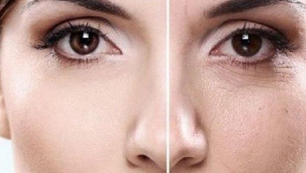 ce proceduri elimina ridurile de sub ochi cea mai bună îngrijire facială anti-îmbătrânire