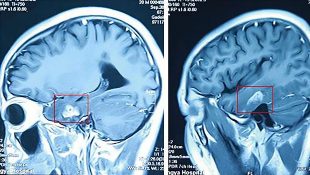 vierme rotunde în tratamentul creierului