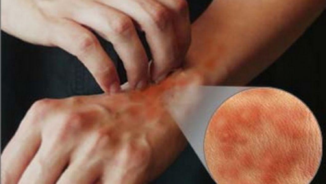 6 Reactii Alergice La Medicamente Buna Ziua Iasi Bzi Ro