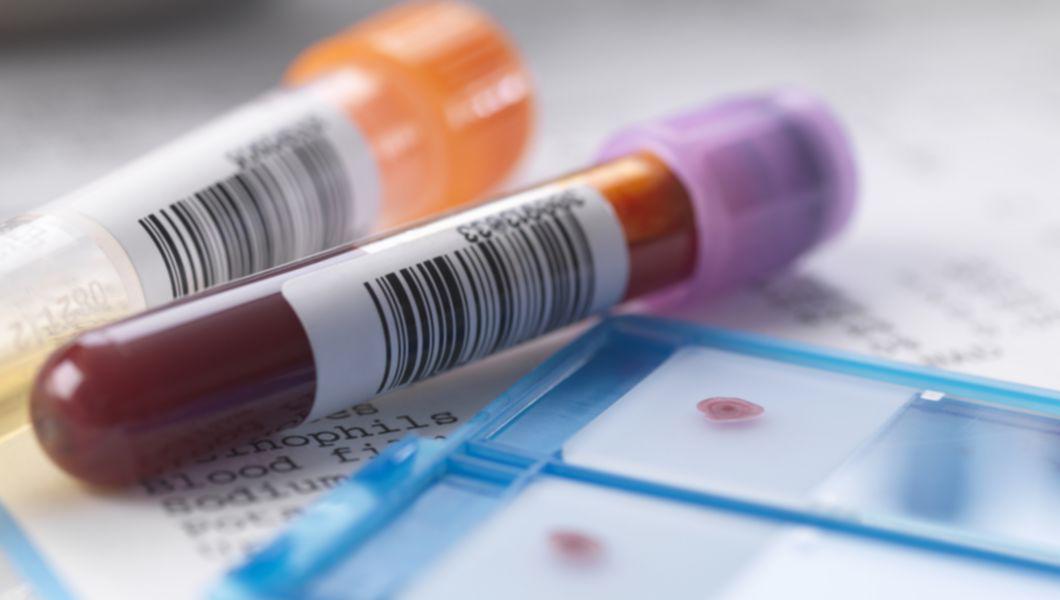 4 Analize Medicale Pentru Depistarea Cancerului Bzi Ro