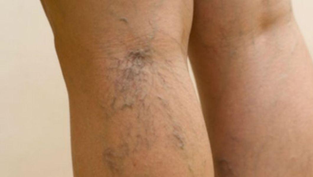 operaiune pentru vene varicoase din makhachkala caracteristicile durerii în piciorul varicos
