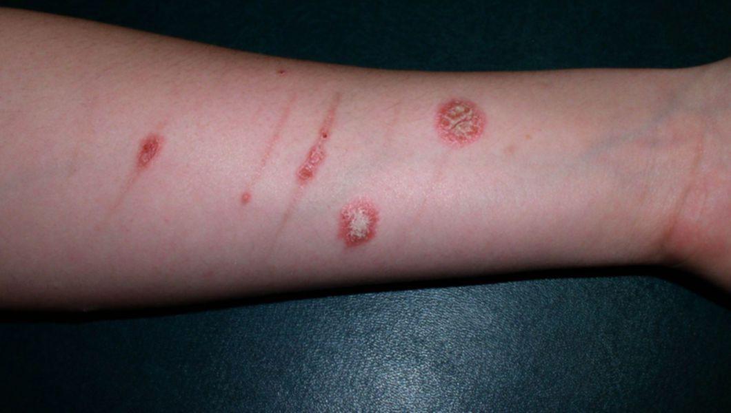 Flumetazon Pivalat Unguent Pentru Eczeme Dermatite