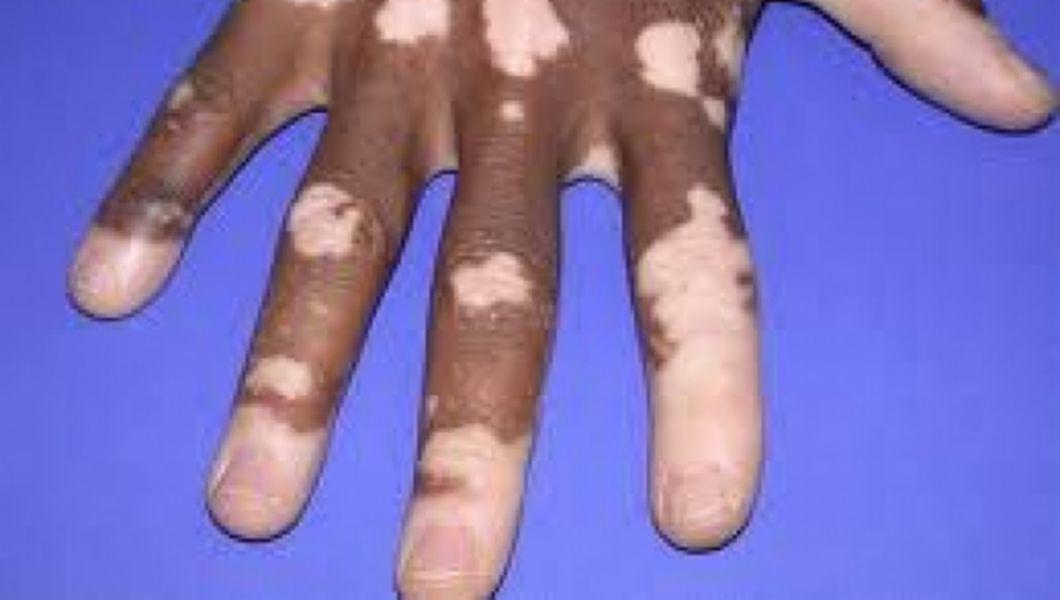 Tratament Recomandat Pentru Vitiligo Buna Ziua Iasi Bzi Ro