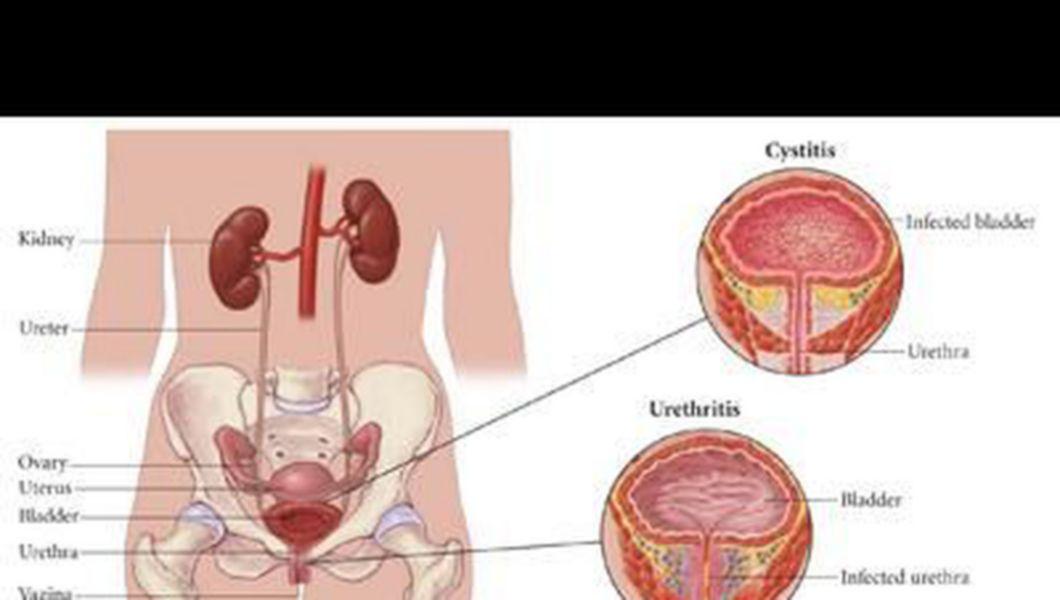 infectia urinara cu e coli tratament rinichii functii