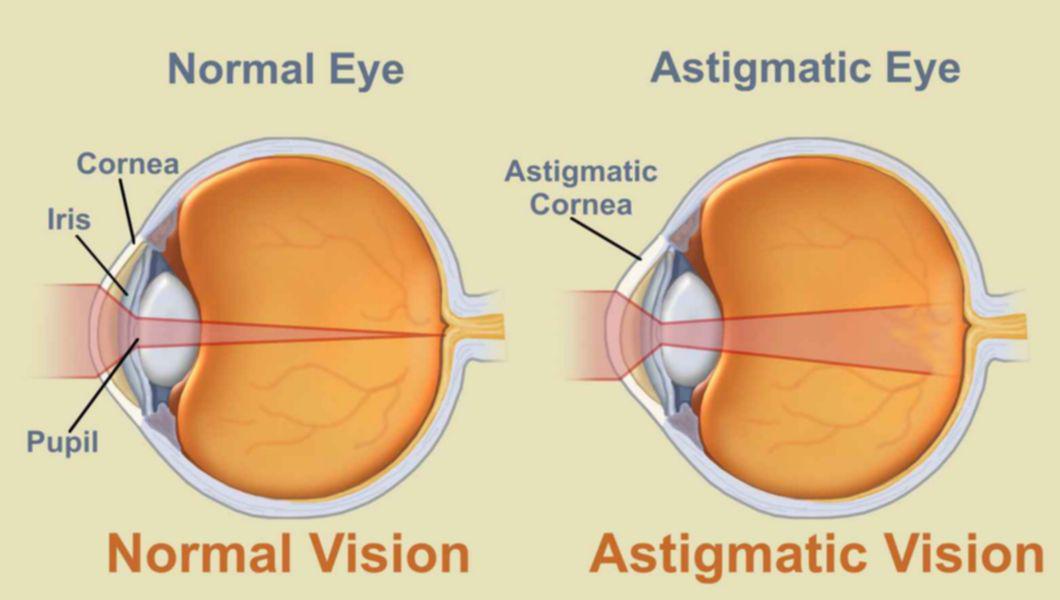 cum se restabilește vederea cu astigmatism