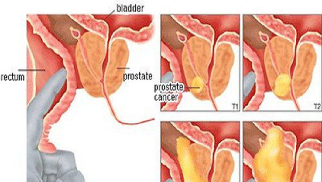 cáncer de próstata grado 3 tratamentul prostatitei la bărbații cu sport