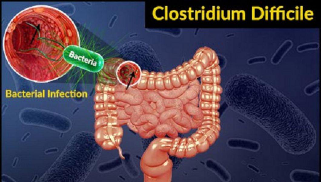 Cum Se Manifesta Infectia Cu Clostridium Difficile Si Cum O Putem Preveni Buna Ziua Iasi Bzi Ro