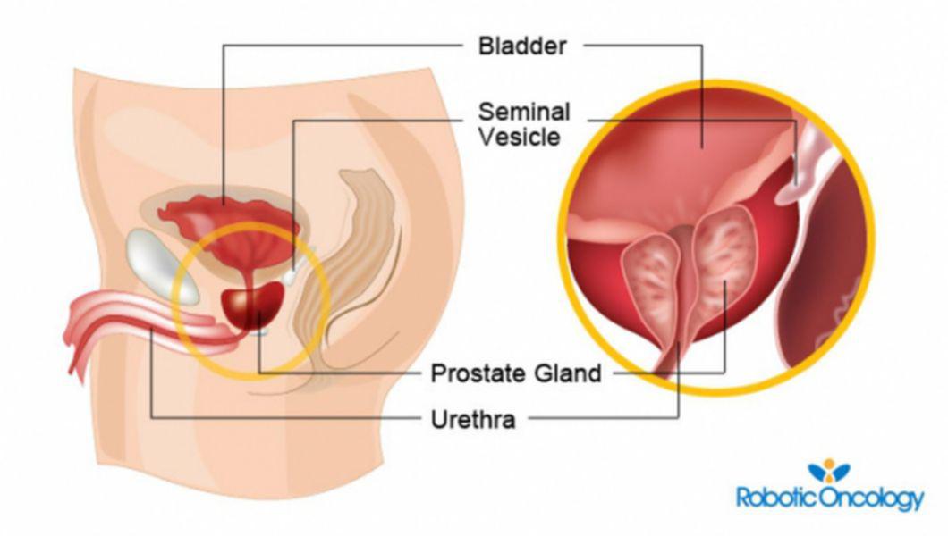 rolul prostatei hiperplasia prostatica grado iv pdf