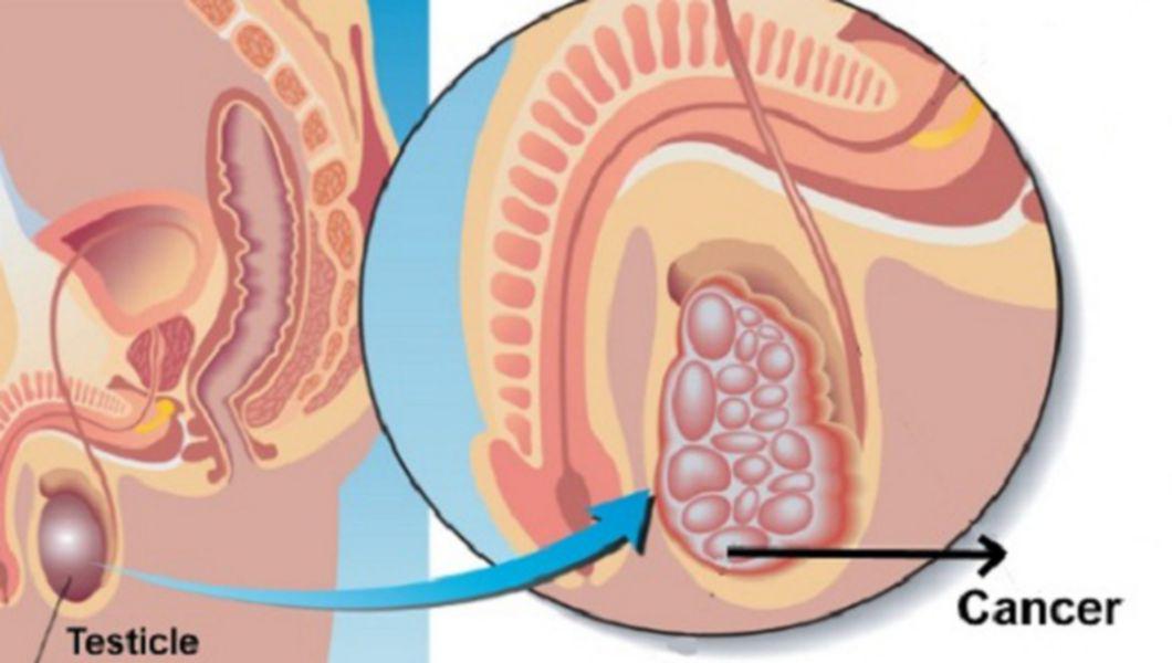 prostatitis bacteriana por e coli dieta consigliata per prostata ingrossata